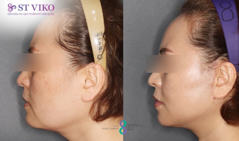chi phí gọt hàm Hàn Quốc
