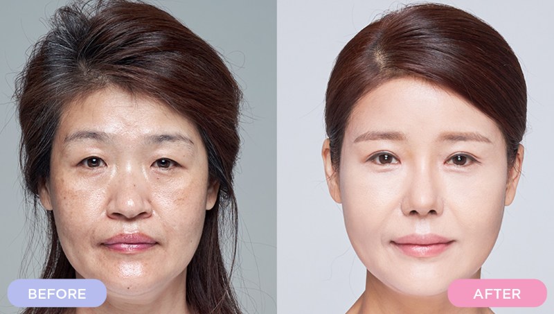 Giá cắt mí Hàn Quốc
