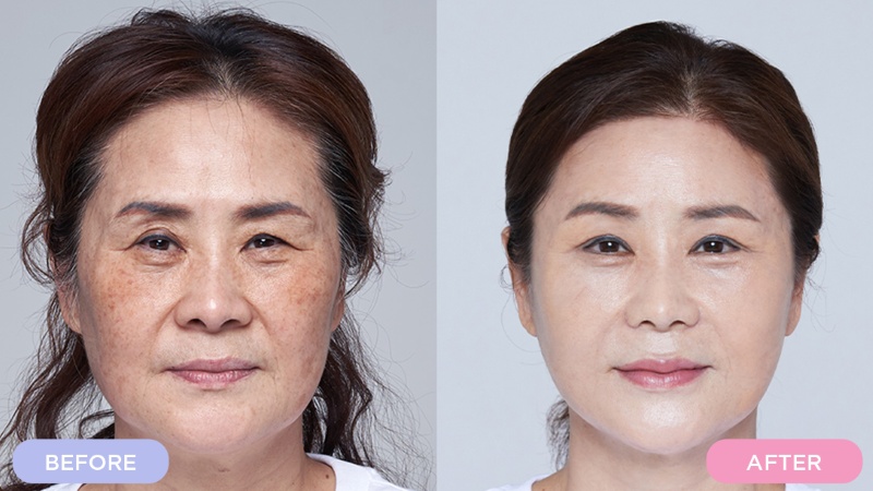 Giá cắt mí Hàn Quốc