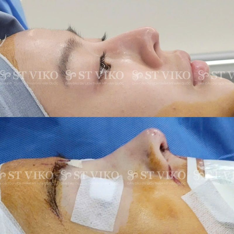 nâng mũi hàn quốc với việt nam