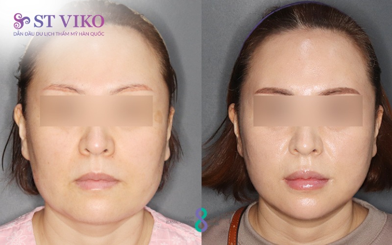 xu hướng thẩm mỹ hàn quốc