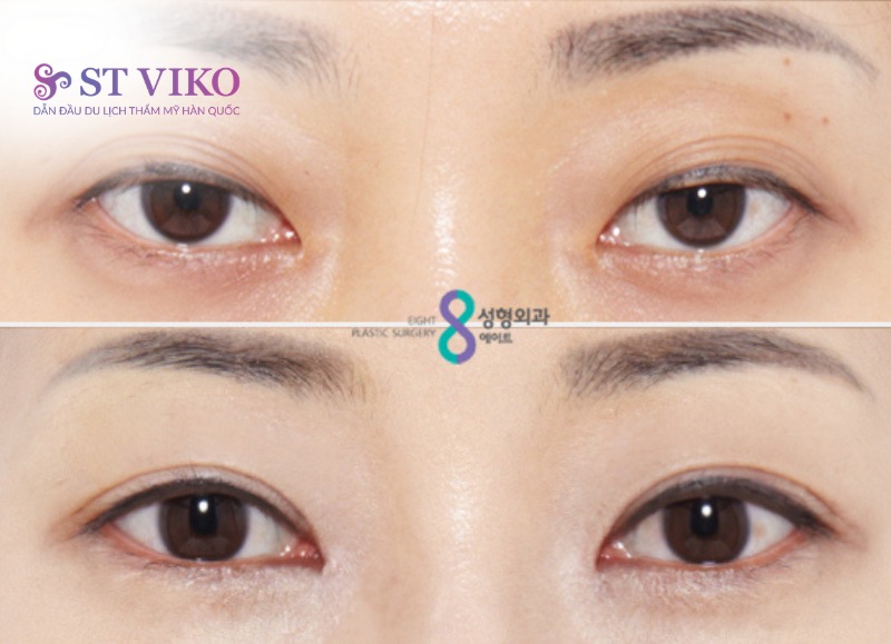 xu hướng thẩm mỹ hàn quốc
