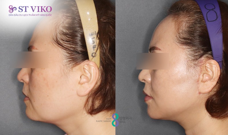 Xu hướng thẩm mỹ Hàn Quốc