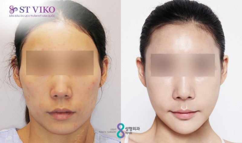 xu hướng thẩm mỹ hàn quốc