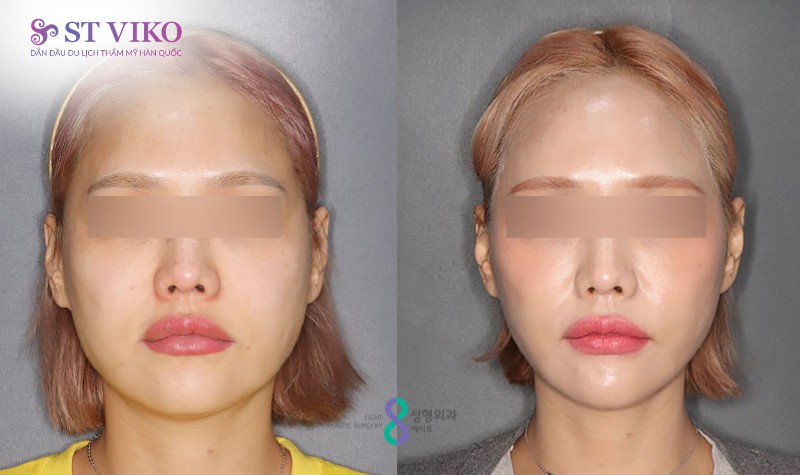 xu hướng thẩm mỹ hàn quốc